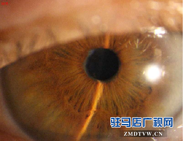 脫貧后，患眼疾20多年重見光明