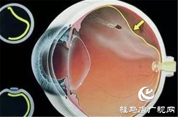 一只眼睛視網(wǎng)膜脫落，另一只也會脫落嗎