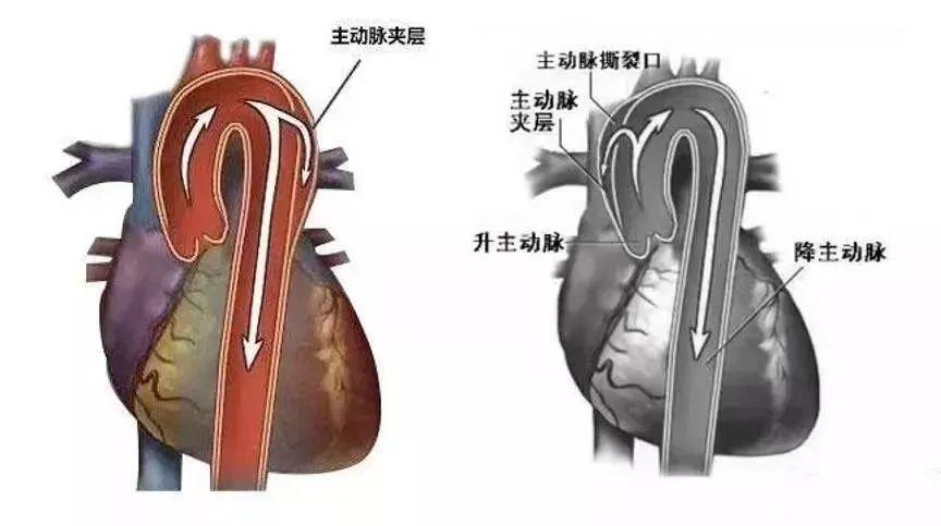 5天接診4例A型主動脈夾層，到底有多兇險