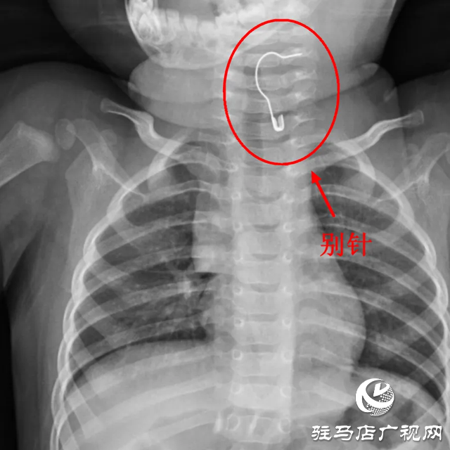 駐馬店10個(gè)月大嬰兒誤吞異物！這東西家家都有 必須放好了！