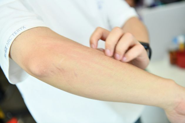 一到夏天手上就長小水泡，皮膚總是又癢又疼？避開這4個誤區(qū)