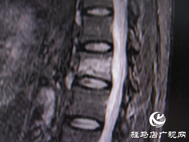 打個噴嚏還能骨折？百歲老人傷不起