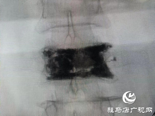 打個噴嚏還能骨折？百歲老人傷不起