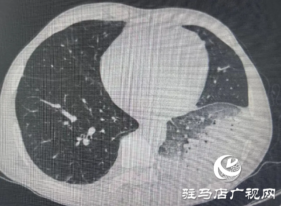 高燒不退、大面積肺炎 不是甲流不是感冒 “元兇”竟在家中！