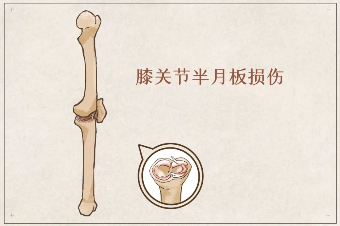 盲目鍛煉？你的半月板傷不起