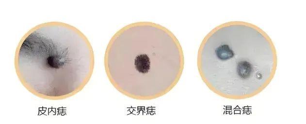危險的痣長啥樣？“ABCDE法則”教你辨別