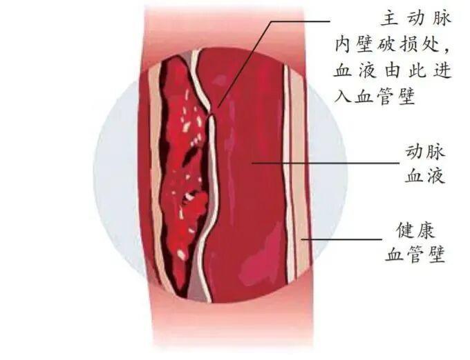 防寒更要防?。♂t(yī)生提醒：別讓低溫“凍”破主動脈