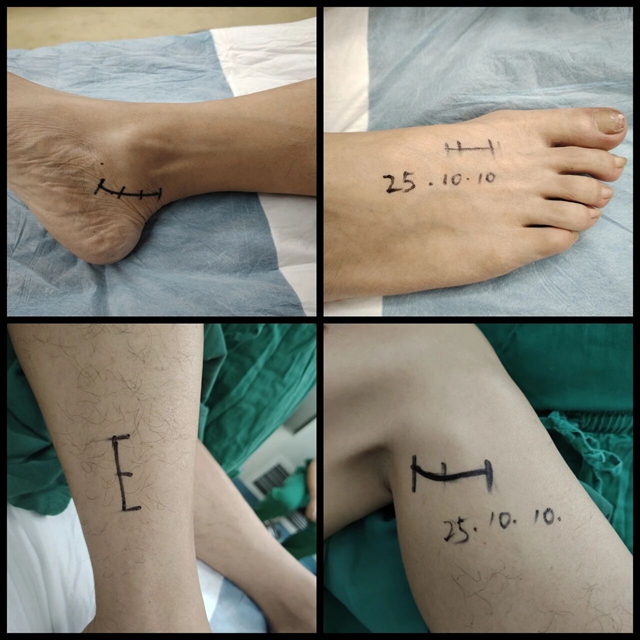 腦外科成功開展周圍神經(jīng)減壓術(shù)，為糖尿病患者解除病痛困擾