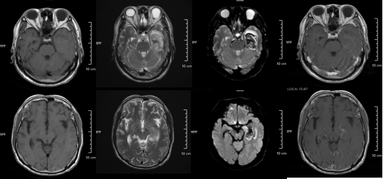 30歲小伙長(zhǎng)期熬夜智力退回3歲 年輕人患“腦膜炎”病例為何頻發(fā)？